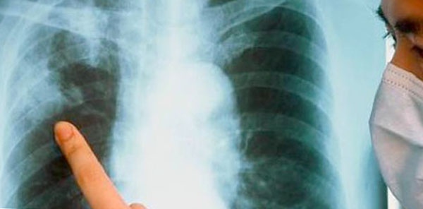 В Киеве зарегистрировано 11 тысяч больных туберкулезом